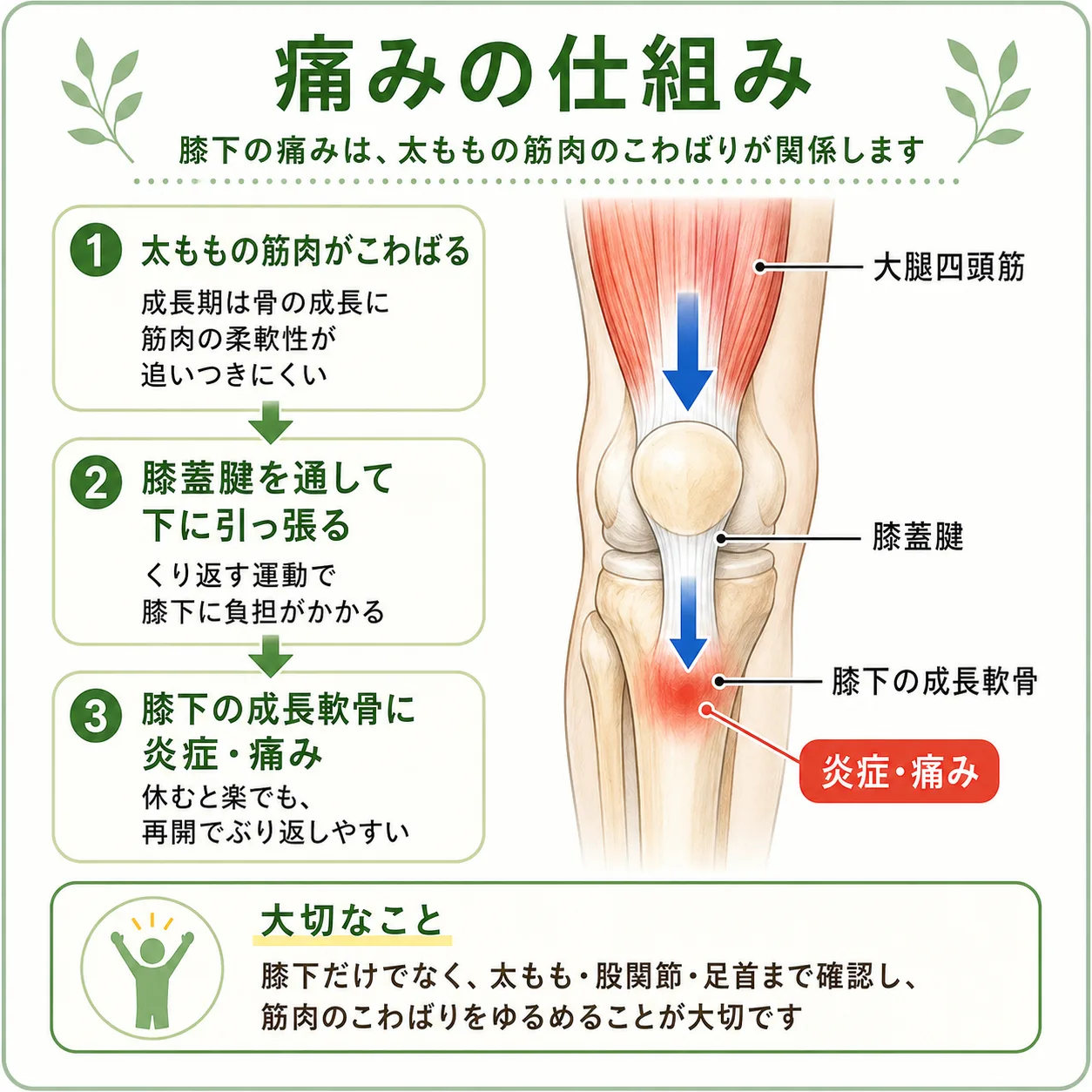 オスグッドの痛みの仕組み。太ももの筋肉のこわばりが膝蓋腱を通して膝下の成長軟骨を引っ張る説明図
